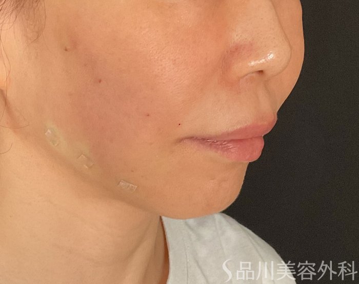 症例NO.75209のAFTER写真