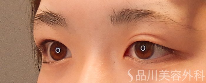 症例NO.69928のBEFORE写真