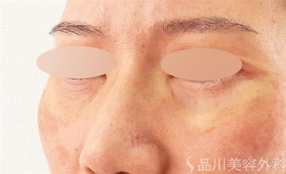 症例NO.61308のAFTER写真