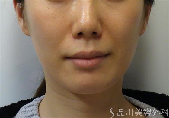 症例NO.39899のBEFORE写真