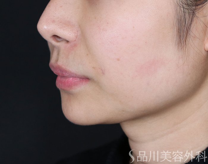 症例NO.73142のBEFORE写真