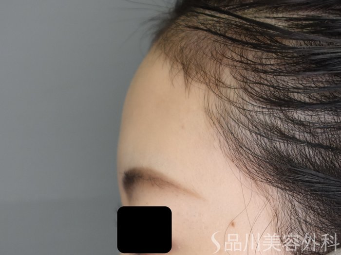 症例NO.70233のBEFORE写真