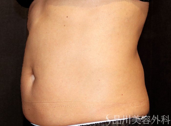 症例NO.72108のBEFORE写真