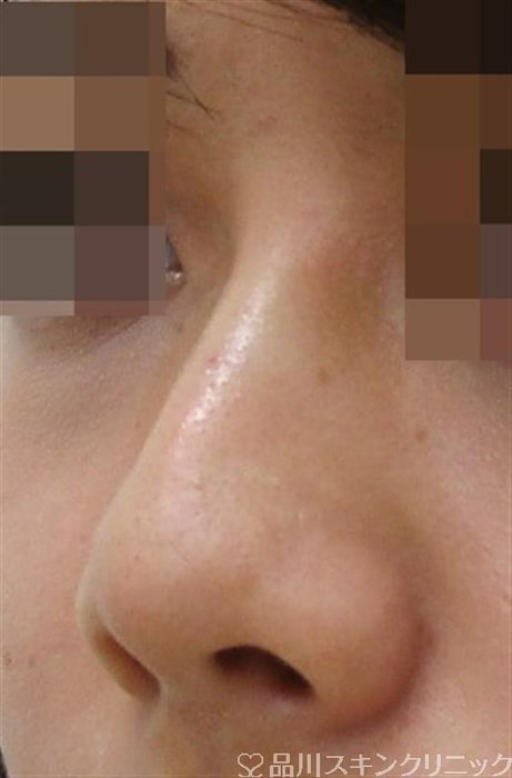 症例NO.40558のAFTER写真
