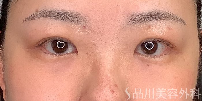 症例NO.71234のAFTER写真