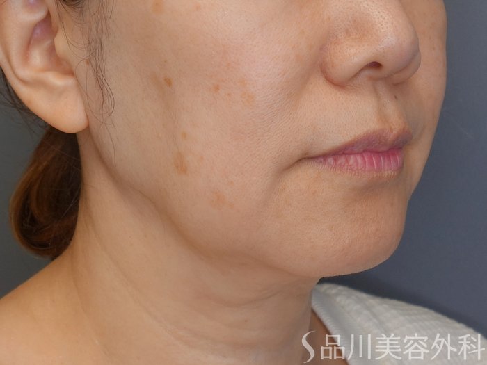 症例NO.70864のBEFORE写真