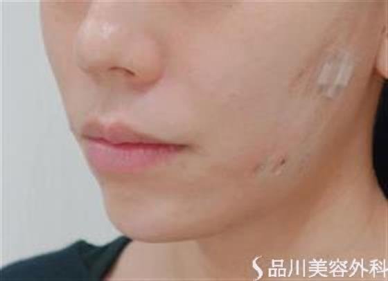 症例NO.47377のAFTER写真