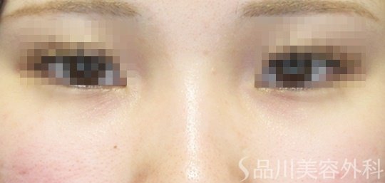 症例NO.68391のBEFORE写真