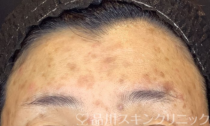 症例NO.65609のBEFORE写真