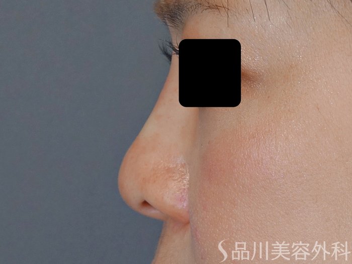 症例NO.67755のAFTER写真