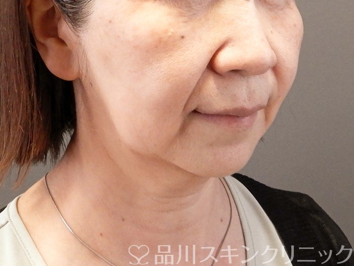 症例NO.66252のBEFORE写真