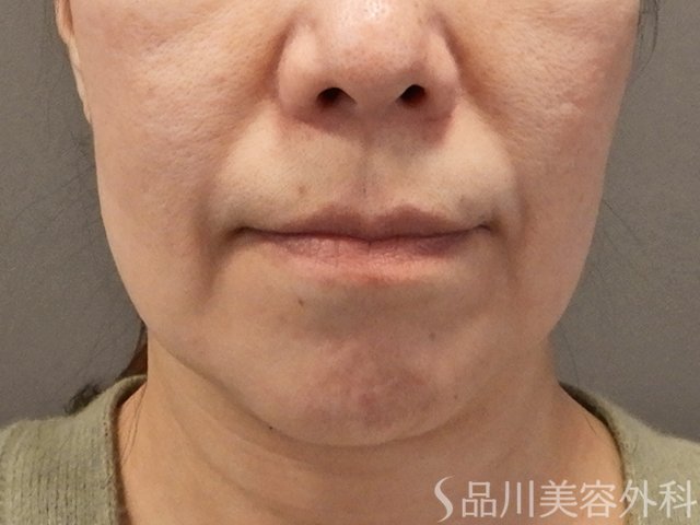 症例NO.73268のBEFORE写真