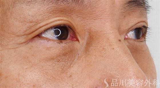 症例NO.49906のAFTER写真