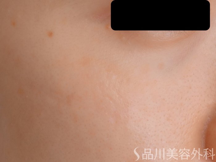 症例NO.70110のAFTER写真