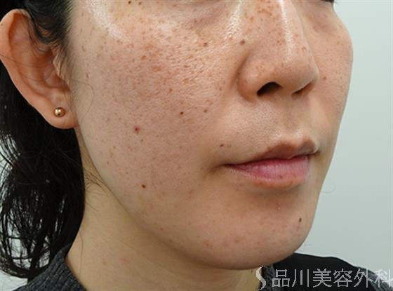 症例NO.46675のBEFORE写真