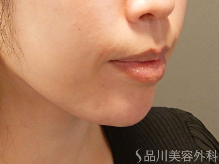 症例NO.69423のAFTER写真