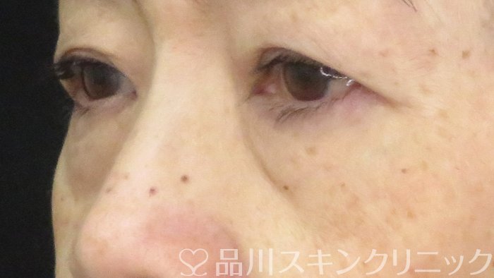 症例NO.71222のBEFORE写真