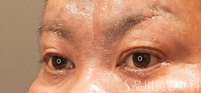 症例NO.69470のAFTER写真