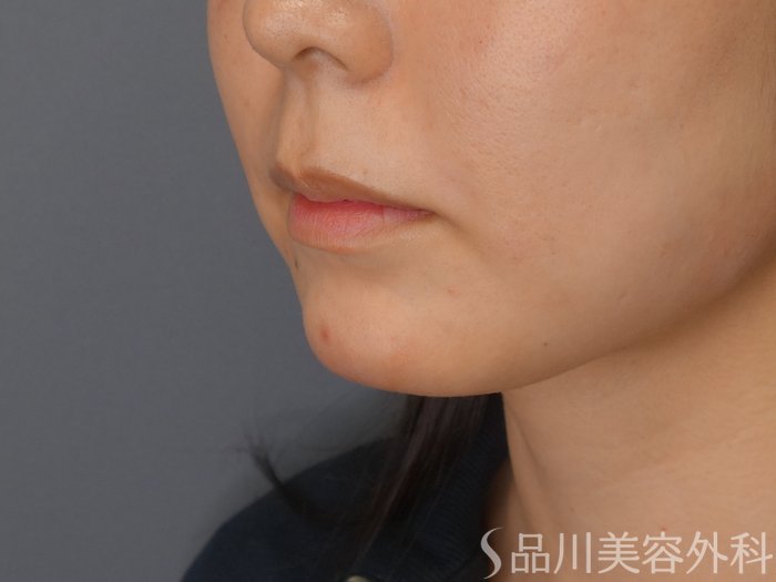 症例NO.68418のAFTER写真