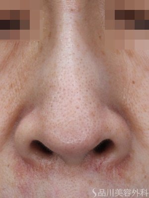 症例NO.69597のBEFORE写真