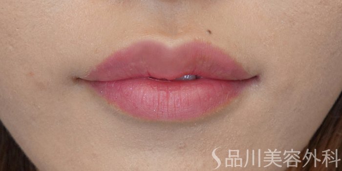 症例NO.71519のAFTER写真