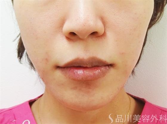 症例NO.32826のAFTER写真
