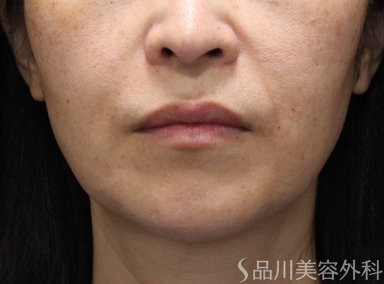症例NO.75263のBEFORE写真