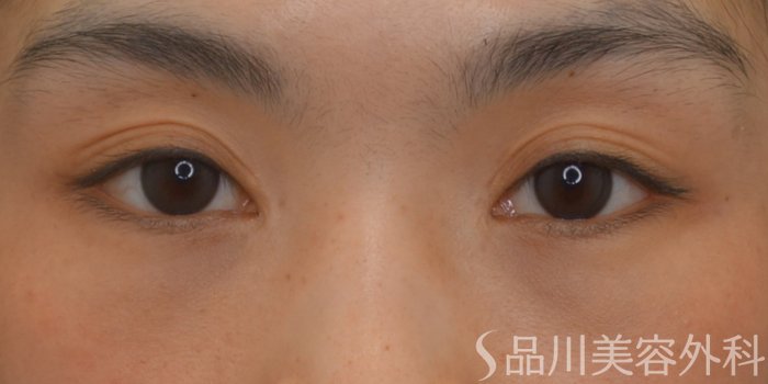 症例NO.74620のBEFORE写真