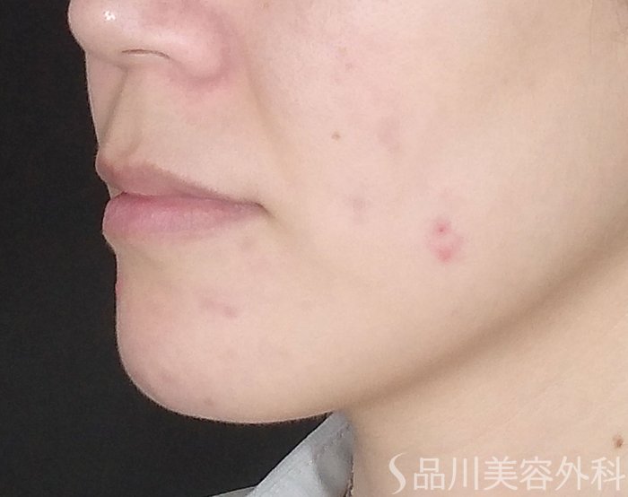 症例NO.69712のBEFORE写真