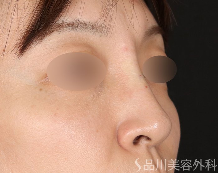 症例NO.71296のAFTER写真