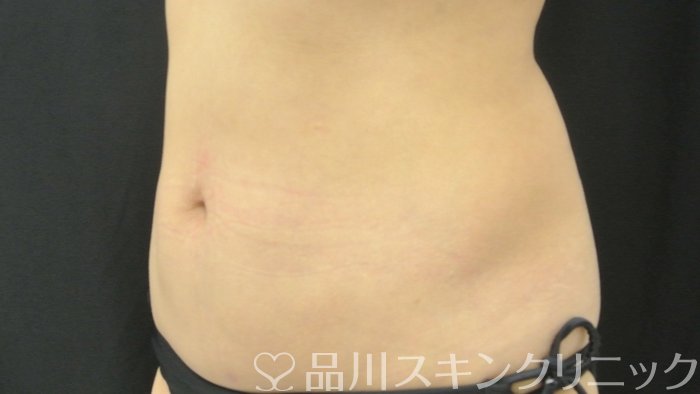 症例NO.70814のAFTER写真