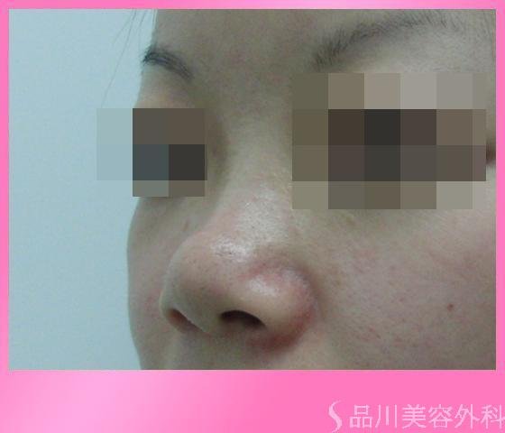症例NO.3003のBEFORE写真
