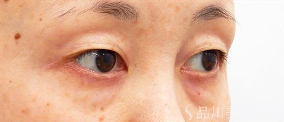 症例NO.53088のBEFORE写真