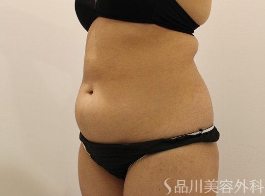 症例NO.74644のBEFORE写真