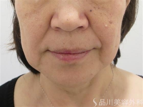 症例NO.24562のBEFORE写真