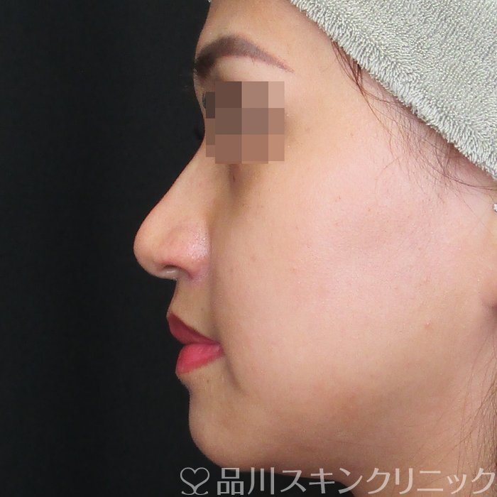 症例NO.74518のAFTER写真