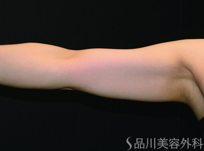 症例NO.65106のAFTER写真