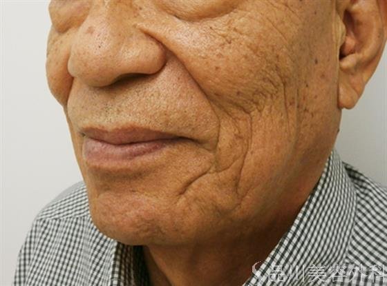 症例NO.30975のBEFORE写真