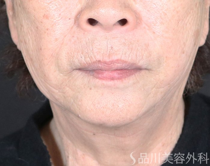 症例NO.73661のAFTER写真