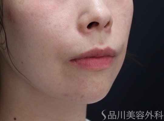 症例NO.71618のBEFORE写真