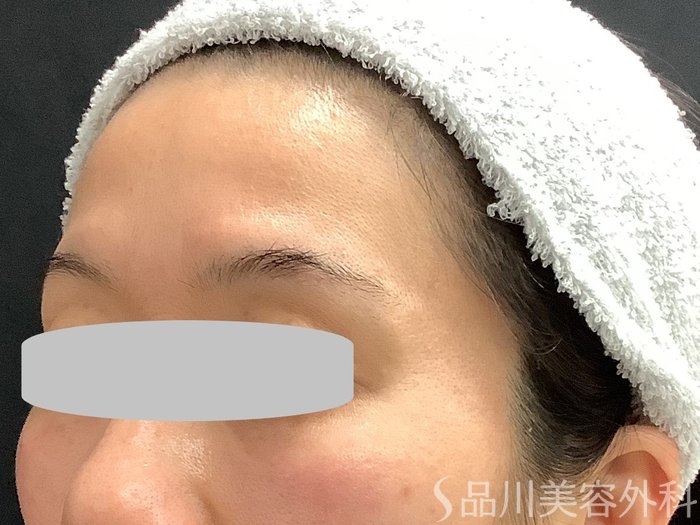 症例NO.67761のBEFORE写真