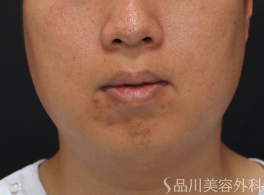 症例NO.74776のBEFORE写真