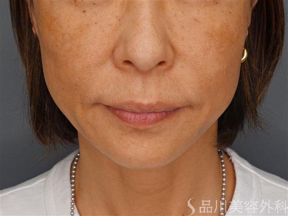 症例NO.60349のBEFORE写真