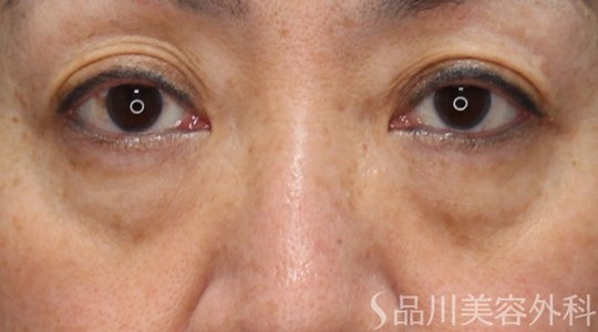 症例NO.71875のBEFORE写真