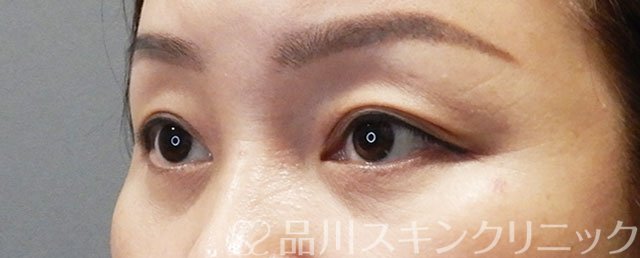 症例NO.73276のBEFORE写真