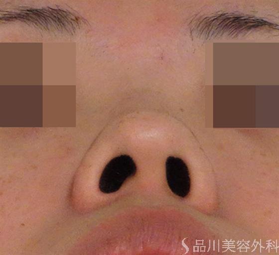 症例NO.40101のBEFORE写真