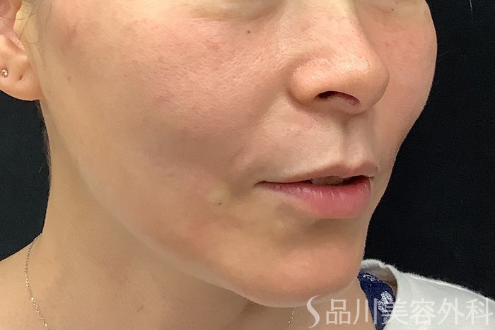 症例NO.71252のAFTER写真