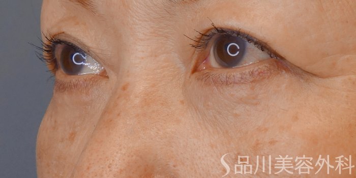 症例NO.72302のAFTER写真