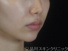 症例NO.74377のAFTER写真