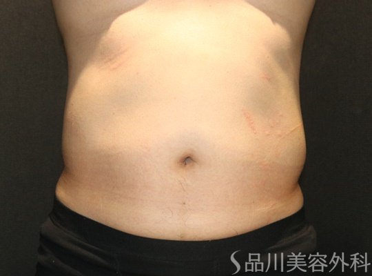 症例NO.75312のBEFORE写真